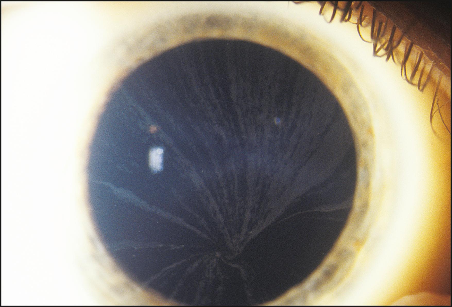 Fig. 7.34, The subtle cornea verticillata in Fabry disease is best seen in sclerotic scatter against the dark background of a well-dilated pupil.