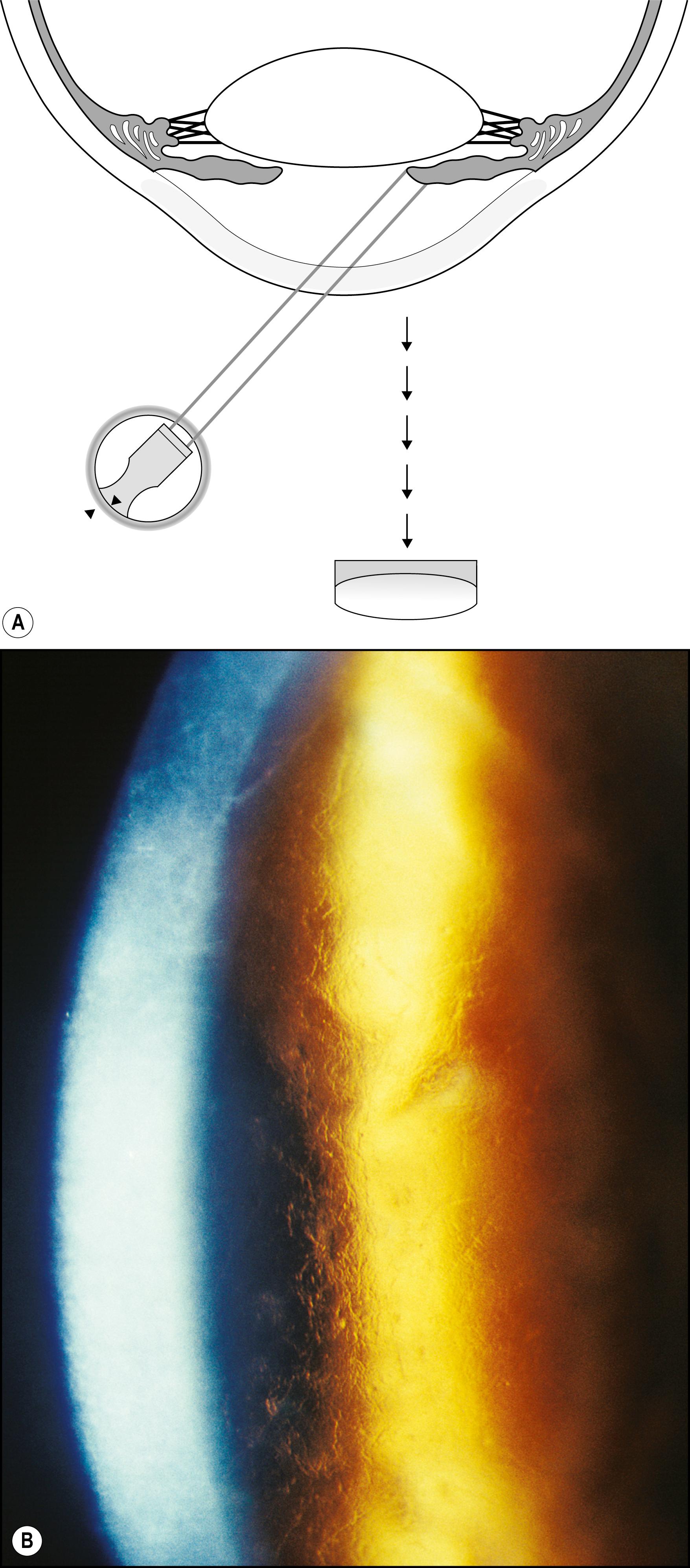 Fig. 7.35, ( A ) and ( B ) The combination of direct and indirect retroillumination from the iris produces remarkable detail of subtle corneal findings, as seen in this example of lattice dystrophy. The zone of interface between light and dark backgrounds is the most informative.