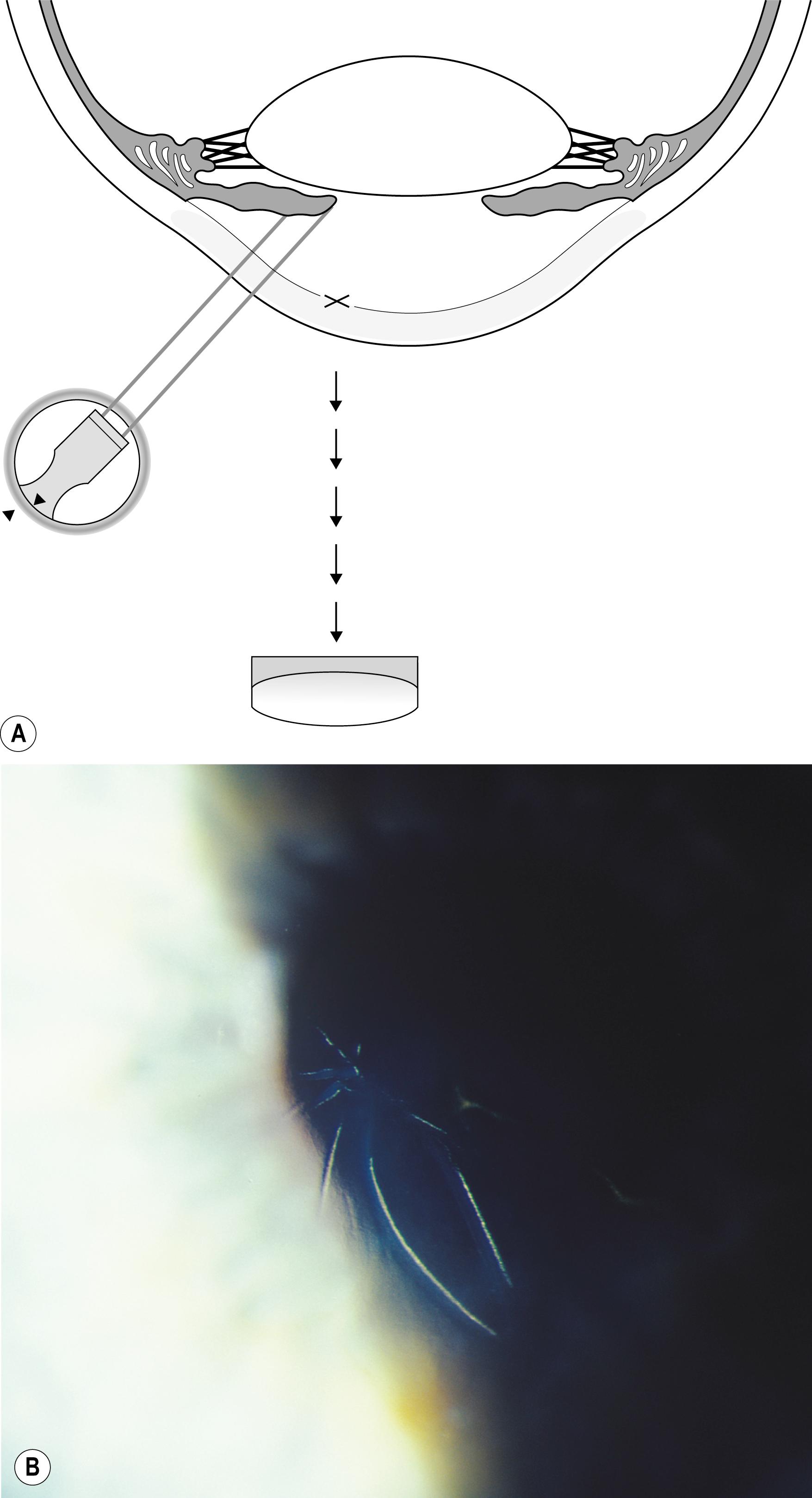 Fig. 7.36, ( A ) and ( B ) Folds in the Descemet membrane are primarily refractile and are best seen against a dark background directly adjacent to the illuminated background.