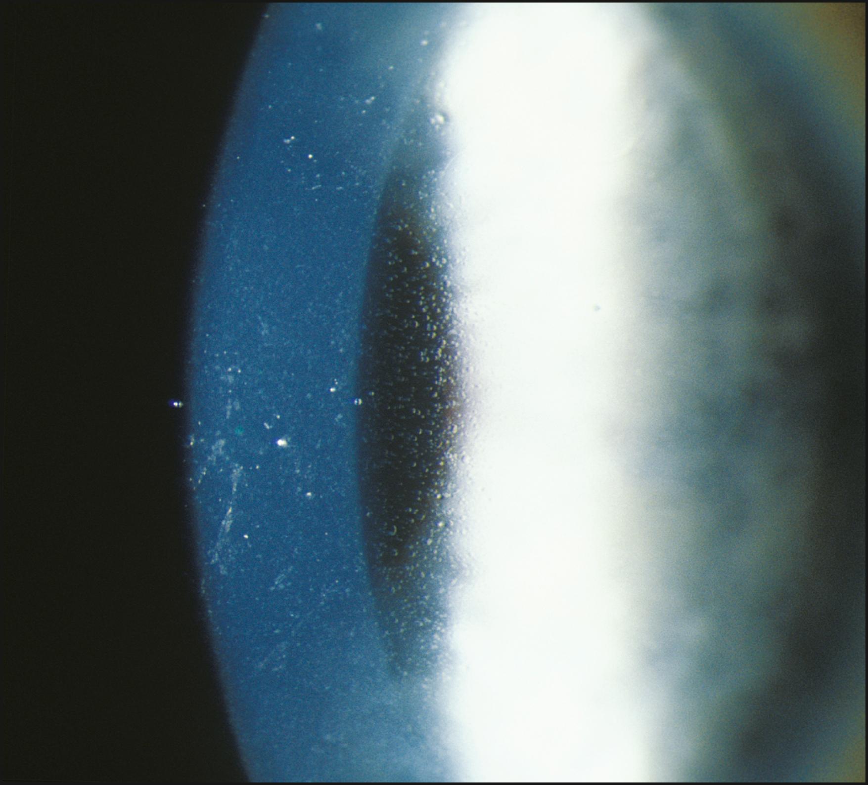 Fig. 7.37, Meesmann dystrophy is effectively demonstrated in indirect retroillumination from the iris.