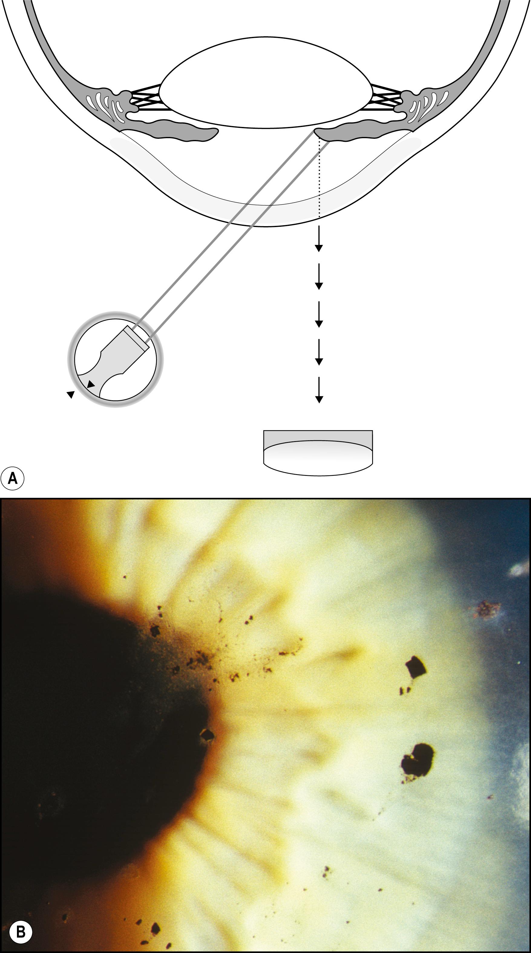 Fig. 7.38, ( A ) Direct retroillumination from the iris. ( B ) Opaque corneal foreign bodies silhouetted against an illuminated, lightly pigmented iris.