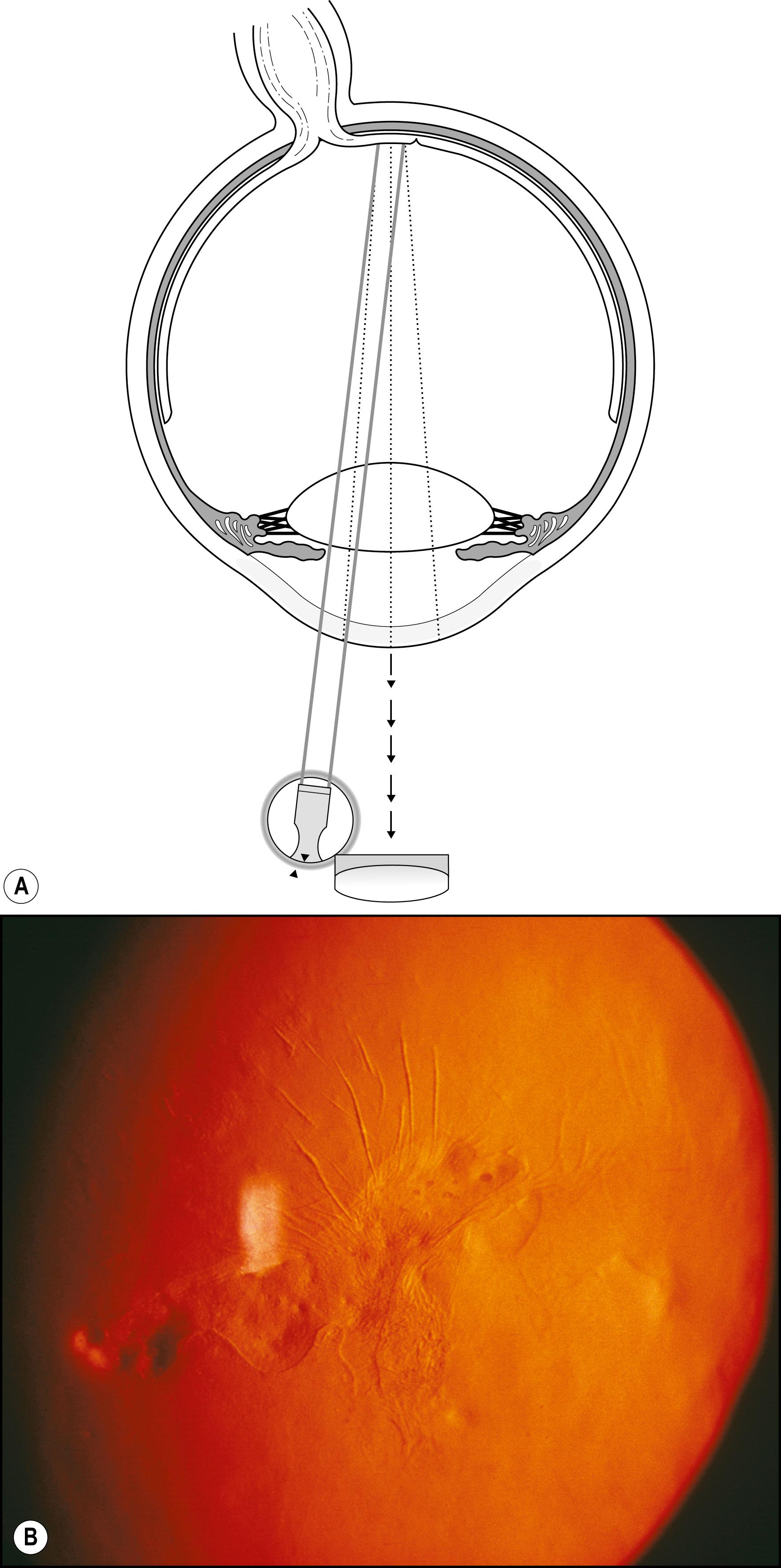 Fig. 7.40, ( A ) and ( B ) Epithelial fingerprint dystrophy is best visualized in retroillumination from the fundus.