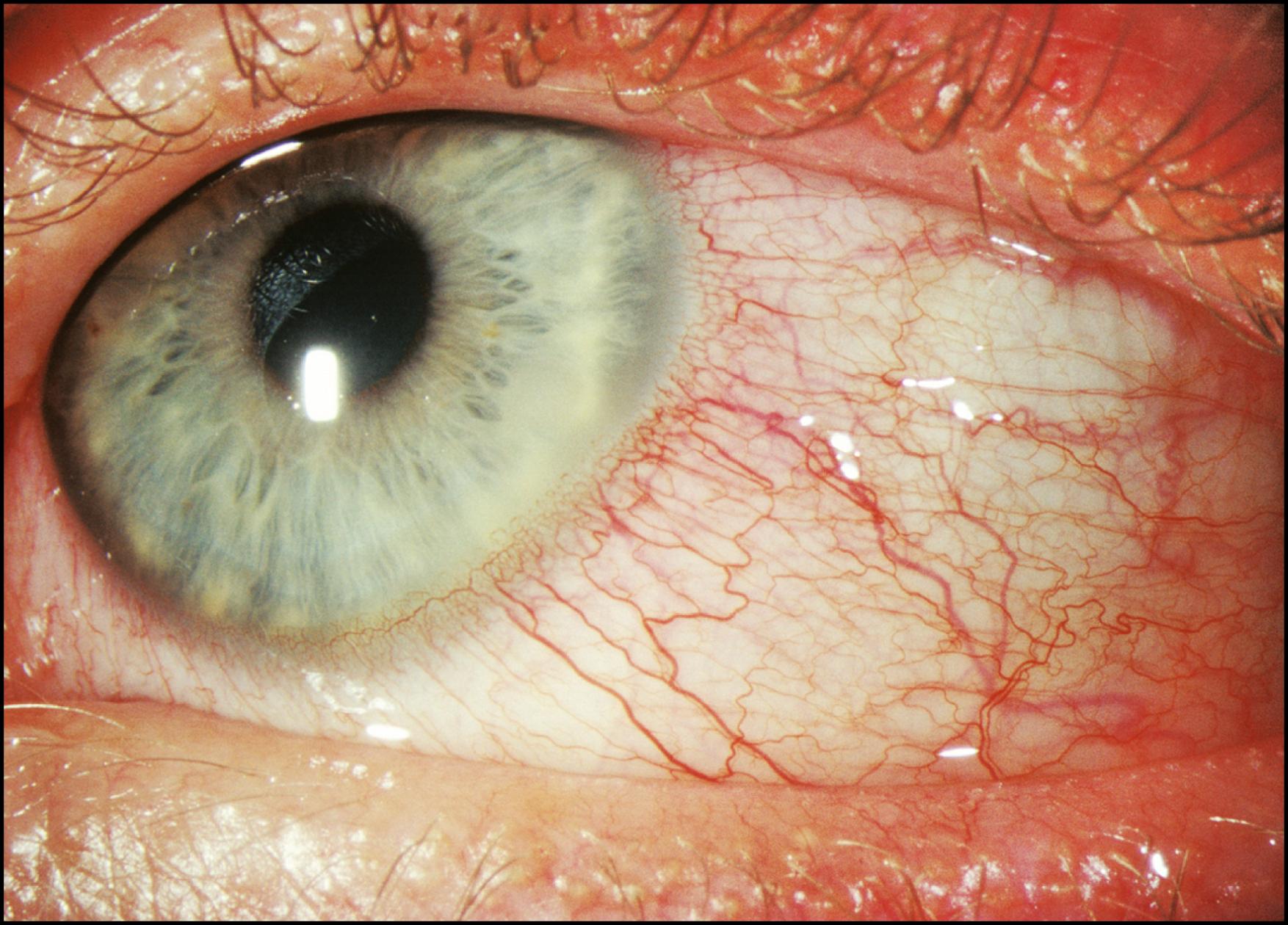 Fig. 7.4, Staphylococcal keratoconjunctivitis and blepharitis are presented in diffuse illumination.