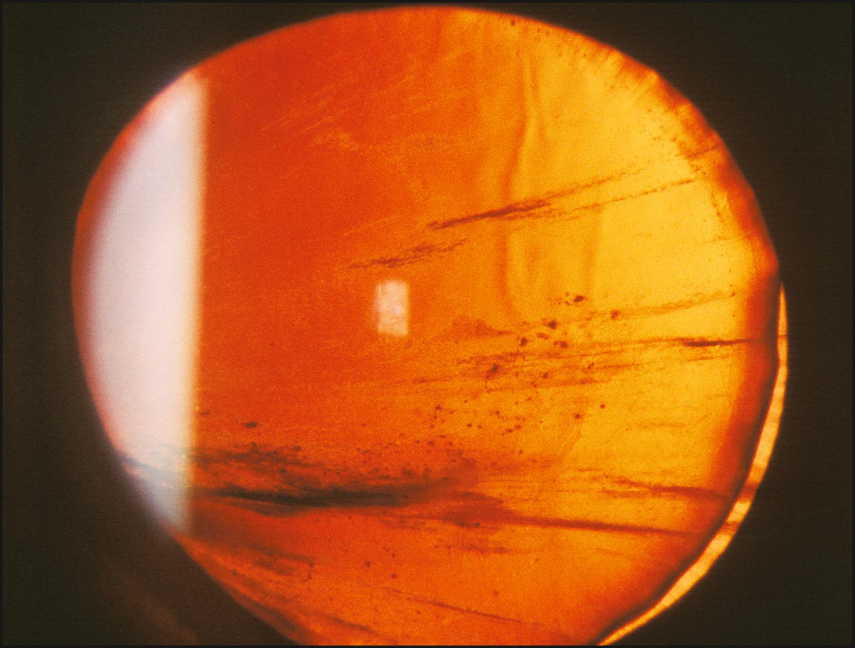 Fig. 7.41, A traumatically subluxated lens is seen with blood on its posterior surface, well demonstrated in retroillumination from the fundus.