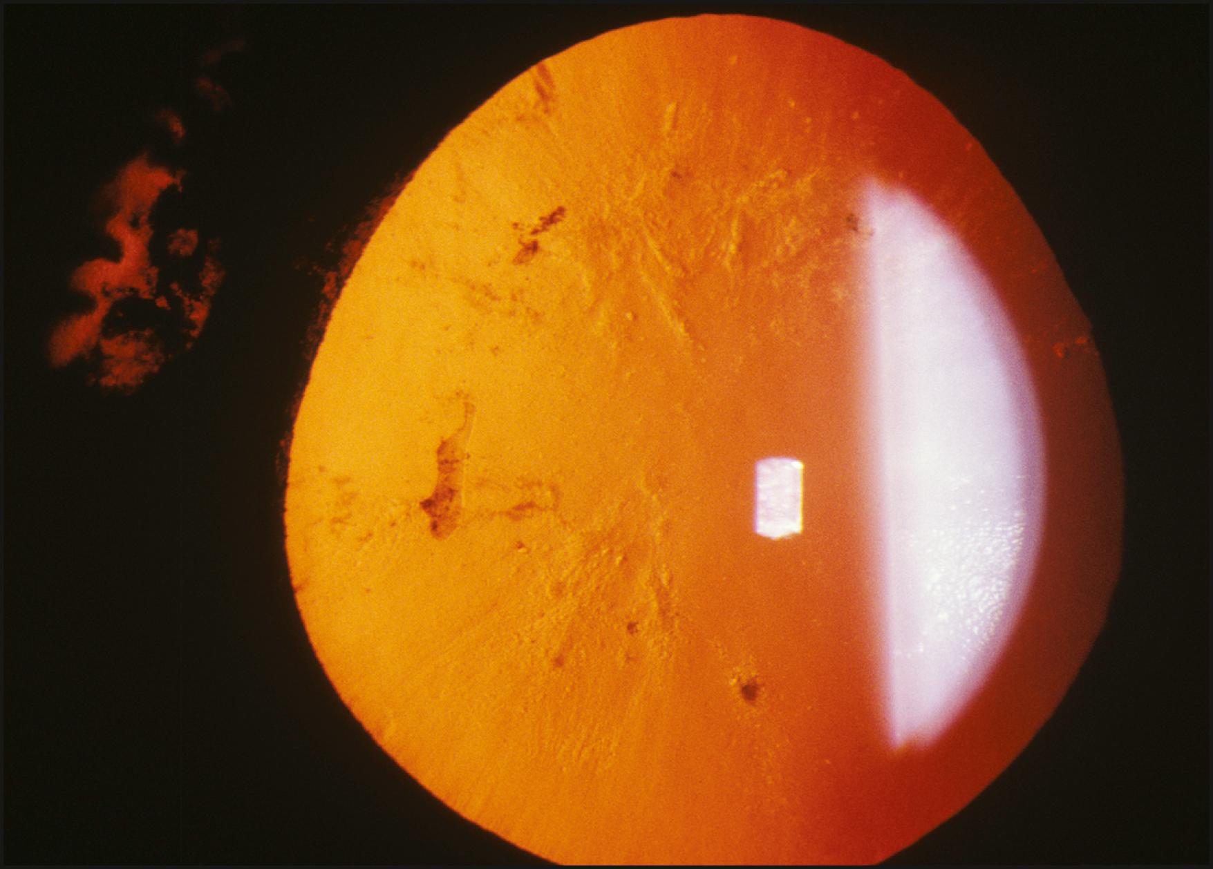 Fig. 7.42, Cataract formation and iris atrophy, resulting from a contusion injury, are simultaneously observed in retroillumination from the fundus and transillumination of the iris.