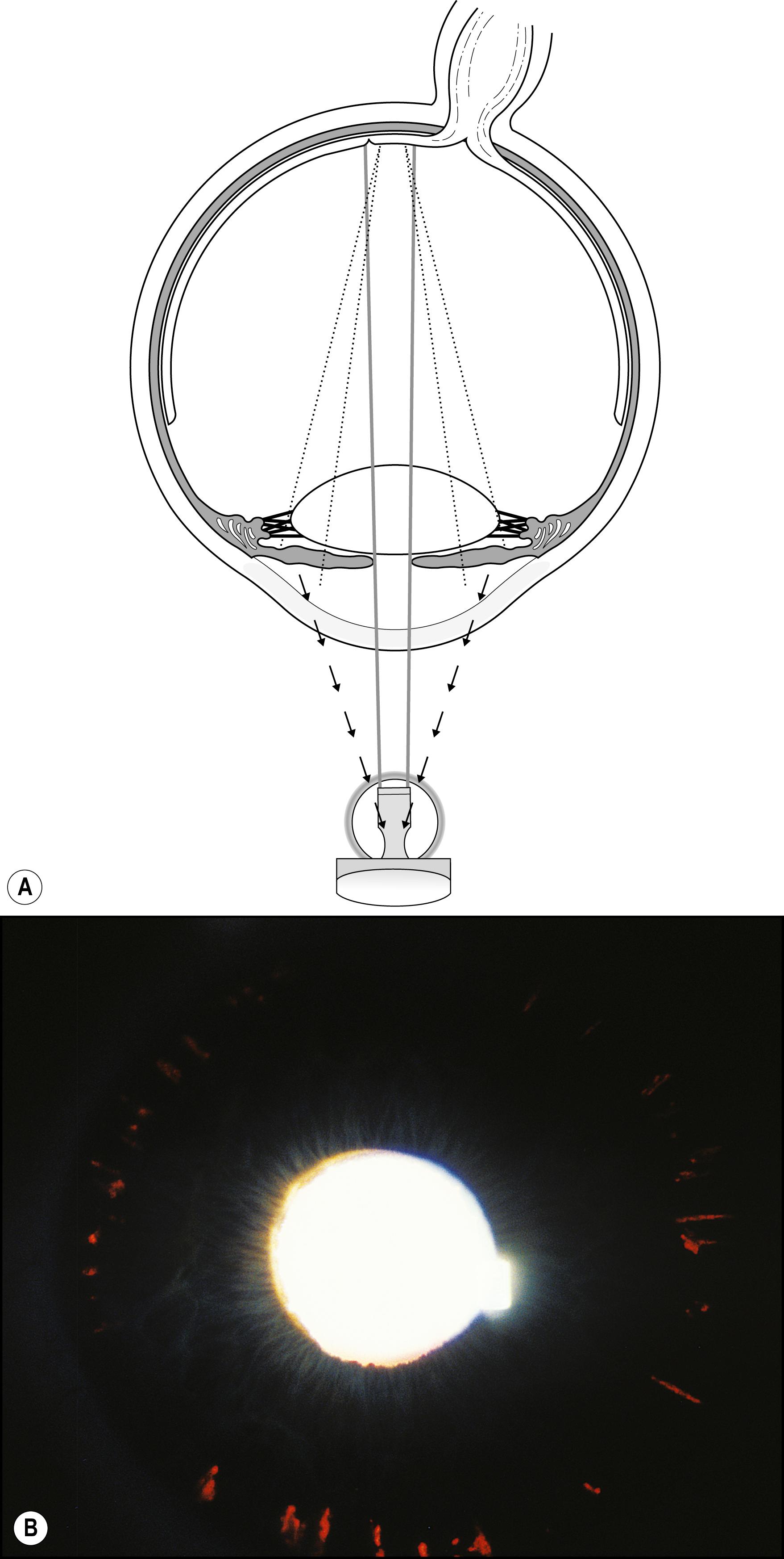 Fig. 7.43, ( A ) and ( B ) Information regarding transmission defects of the iris in pigment dispersion syndrome is maximized by projecting a small round beam through a partially dilated pupil.