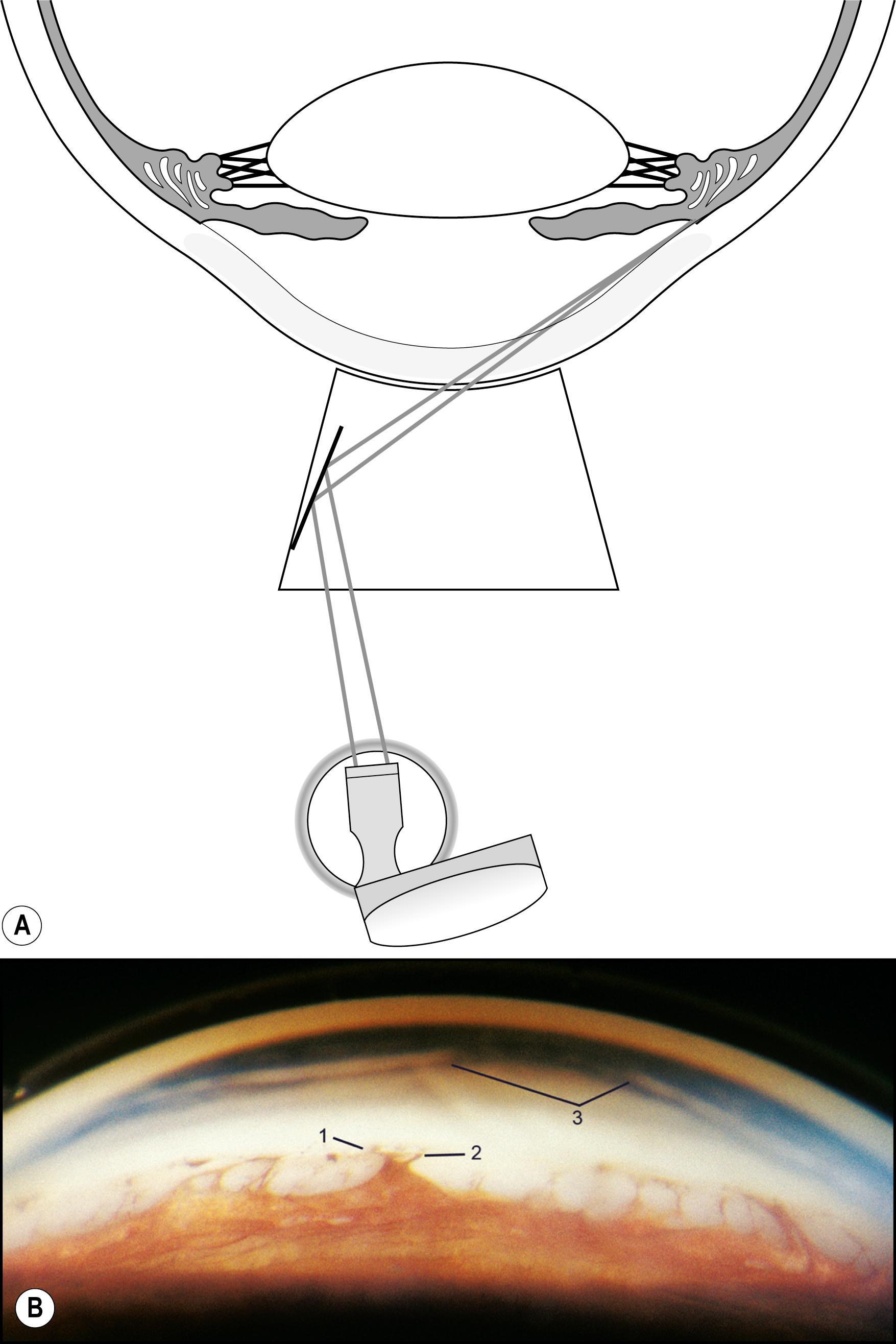 Fig. 7.44, ( A ) View of the peripheral cornea through a three-mirror lens. ( B ) A prominent Schwalbe line (1) is seen, with adherent iris strands (2). Haab striae (3) of the cornea prevent an optimum view in this case of Axenfeld syndrome.