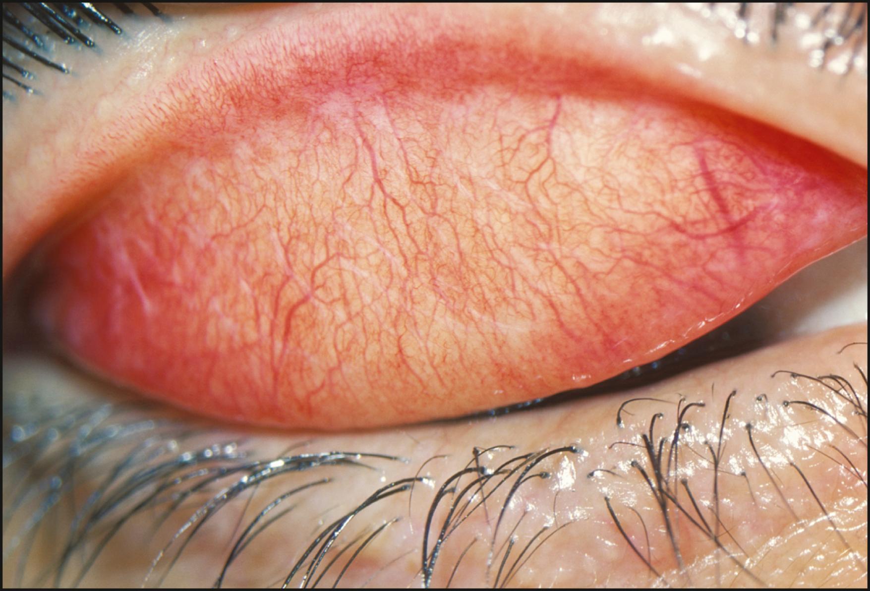 Fig. 7.5, Trachoma with linear scarring seen in diffuse illumination.