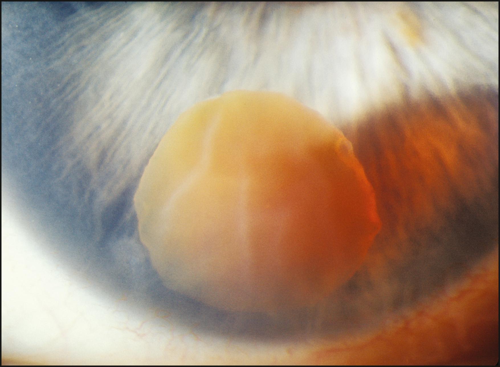 Fig. 7.7, Broad-beam illumination demonstrating a luxated, mature lens nucleus in the anterior chamber. The tangentially applied light dramatizes dimension and minimizes reflections from overlying surfaces.