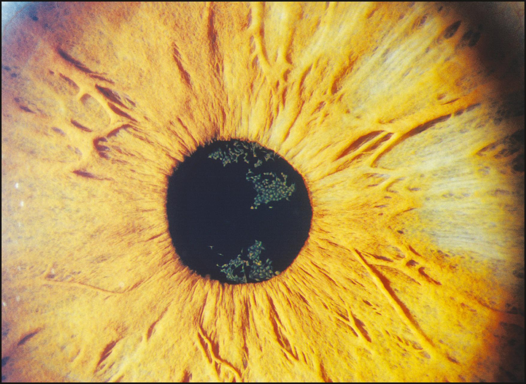 Fig. 7.8, Broad-beam illumination of the iris and anterior lens surface in Rieger syndrome.