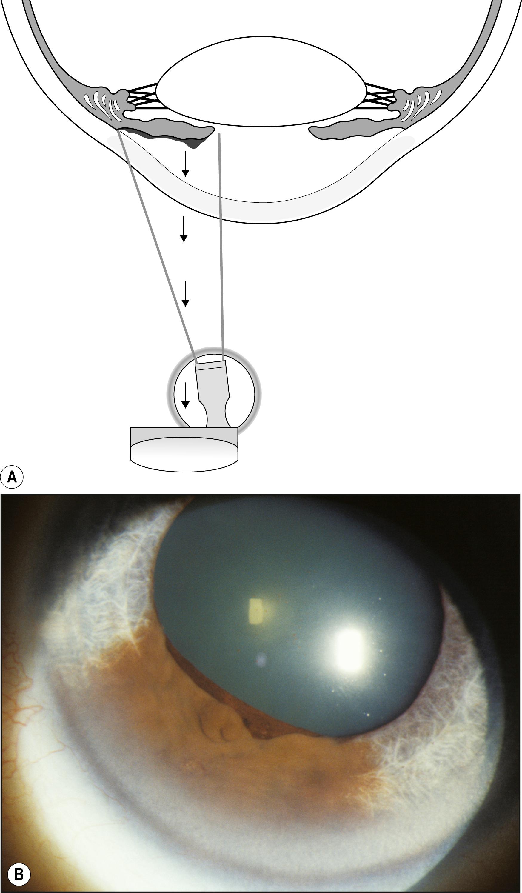 Fig. 7.9, ( A ) and ( B ) This iris lesion is deemphasized by the diffusing axial reflection of light and the lack of highlights and shadows to demonstrate its dimensional nature.