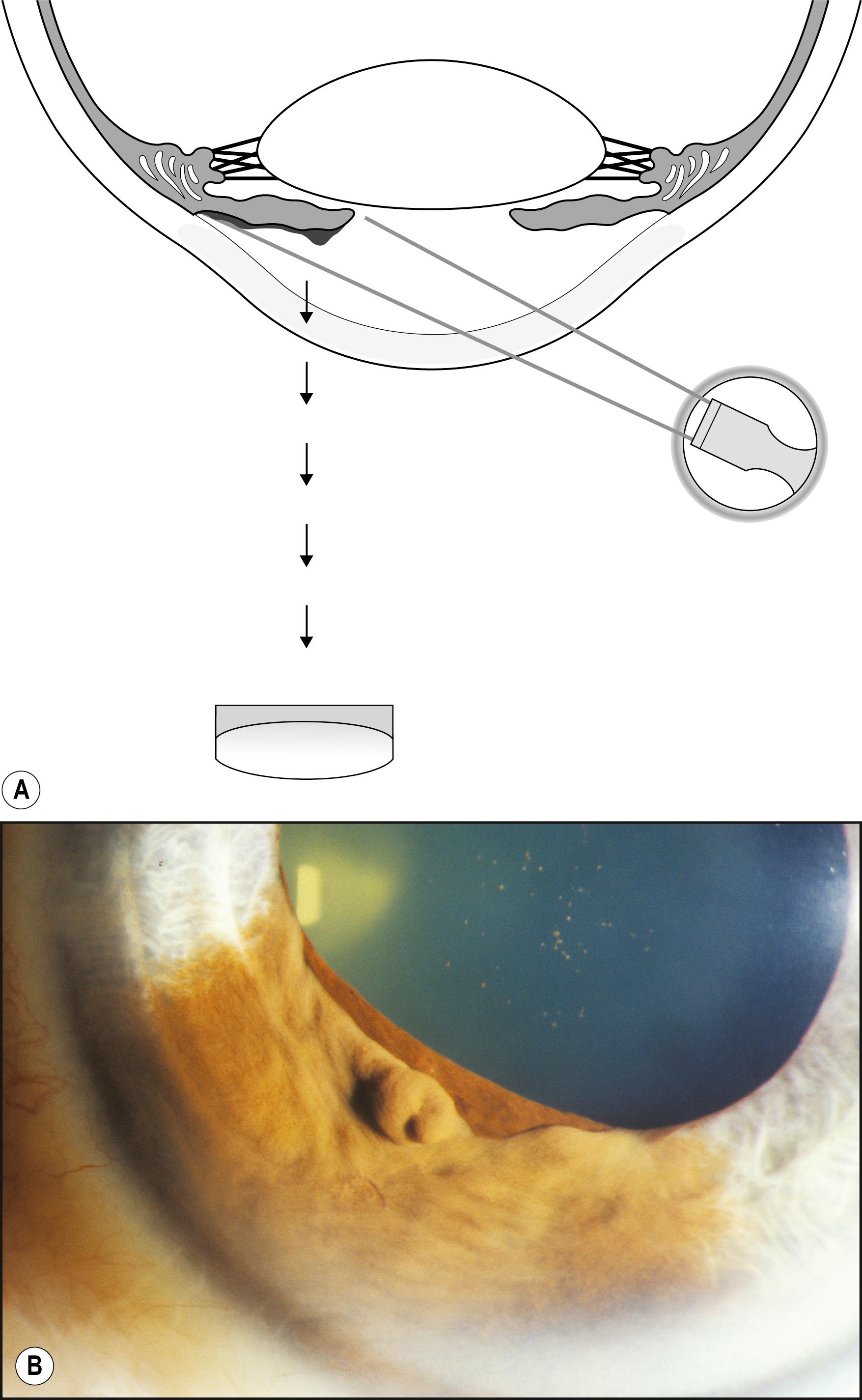 Fig. 7.10, ( A ) and ( B ) A tangentially applied beam will obviate the reflections inherent in axial illumination and will dimensionalize the subject with the highlights and shadows it creates.