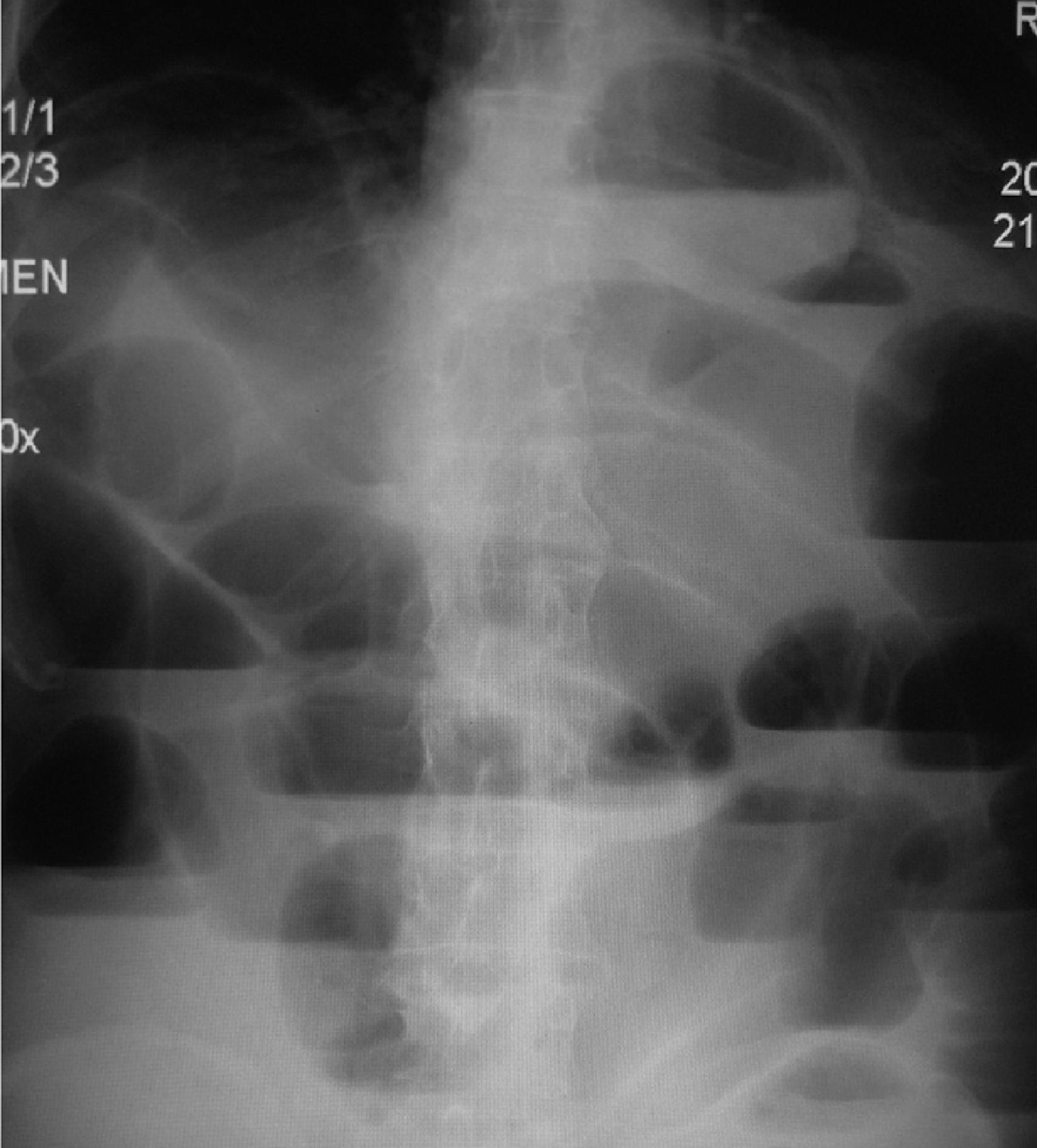 FIG. 1, Plain x-ray of the abdomen showing many distended small bowel loops caused by a distal obstruction.