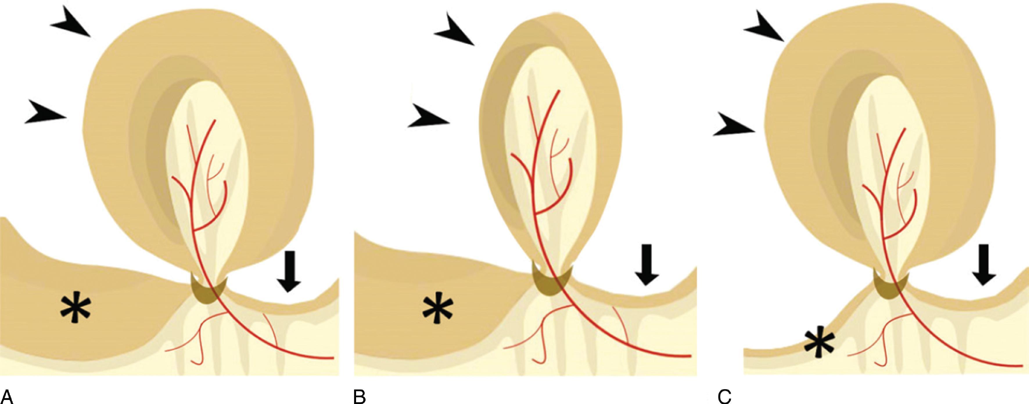 FIG. 2, Diagram of the three CT patterns of closed-loop small bowel obstruction, which is defined as obstruction of the bowel lumen at two sites located next to each other, creating a closed loop. (A) In typical closed-loop obstruction, the afferent loop (asterisk) and closed loop (arrowheads) are dilated and the efferent loop (arrow) is collapsed. (B) In collapsed closed-loop obstruction, the closed loop (arrowheads) is collapsed, the afferent loop (asterisk) is dilated, and the efferent loop (arrow) is collapsed. (C) In flat-belly closed-loop obstruction, the closed loop is dilated (arrowheads) and the afferent (asterisk) and efferent (arrow) loops are collapsed. (From Rondenet C, Millet I, Corno, L., et al. CT diagnosis of closed loop bowel obstruction mechanism is not sufficient to indicate emergent surgery. Eur Radiol. 2020;30:1105–1112.)