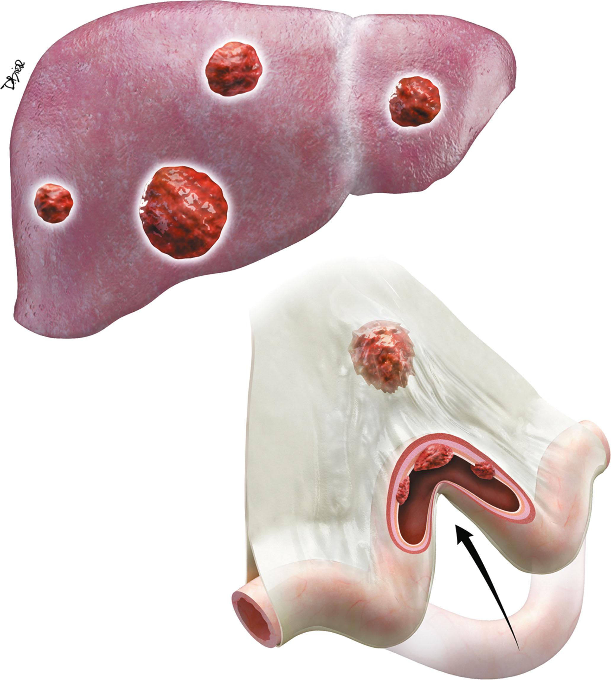 Figure 17.2, Small bowel (SB) carcinoid metastatic pathway into the mesentery and the liver. Desmoplastic reaction causes thickening and shortening of the mesentery and tethering of the SB loop ( arrow ).