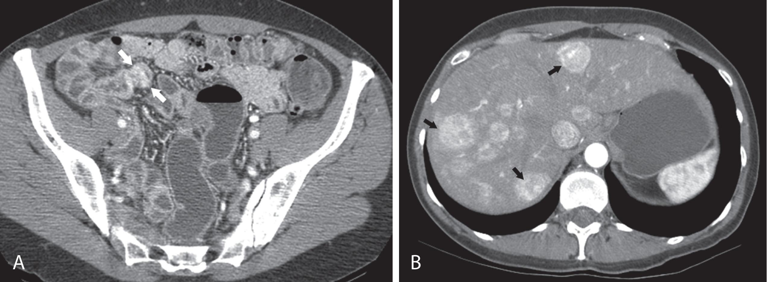 Figure 17.3, A 54-year-old woman with liver metastases found incidentally on a workup for renal colic. A , Computed tomography (CT) scan through the pelvis shows a subtle, very small hyperenhancing segment ( arrows ) in the ileum. On surgery, five carcinoids were found in this segment, ranging from 0.5 to 1.1 cm. B , An arterial phase of multiphase staging CT of the liver demonstrates multiple hyperenhancing liver metastases of a well-differentiated neuroendocrine carcinoma (carcinoid) ( arrows ).