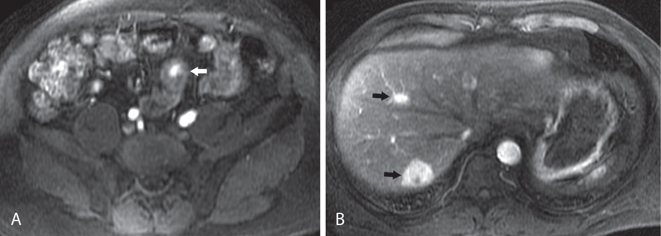 Figure 17.4, A 66-year-old man with multiple liver metastases of carcinoid incidentally found on the routine staging computed tomography scan for treated prostate cancer. A , Fat-suppressed magnetic resonance imaging (MRI) liver acquisition with volume acquisition (LAVA) with gadolinium shows a small hyperenhancing focus in the ileum representing the primary carcinoid ( arrow ). B , Fat-suppressed MRI LAVA with gadolinium shows two hyperenhancing liver metastases ( arrows ).