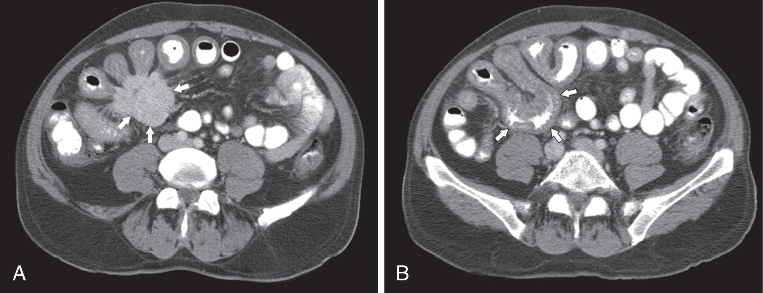 Figure 17.6, A 44-year-old man with carcinoid syndrome. A , Computed tomography (CT) shows a mesenteric mass ( arrows ) with tethering of small bowel (SB) loops because of desmoplastic reaction, representing mesenteric nodal metastasis. B , CT shows a long segment of thickened SB around the mesenteric metastasis, characteristic of carcinoid ( arrows ). On other slices, liver metastases were noted, accounting for carcinoid syndrome.