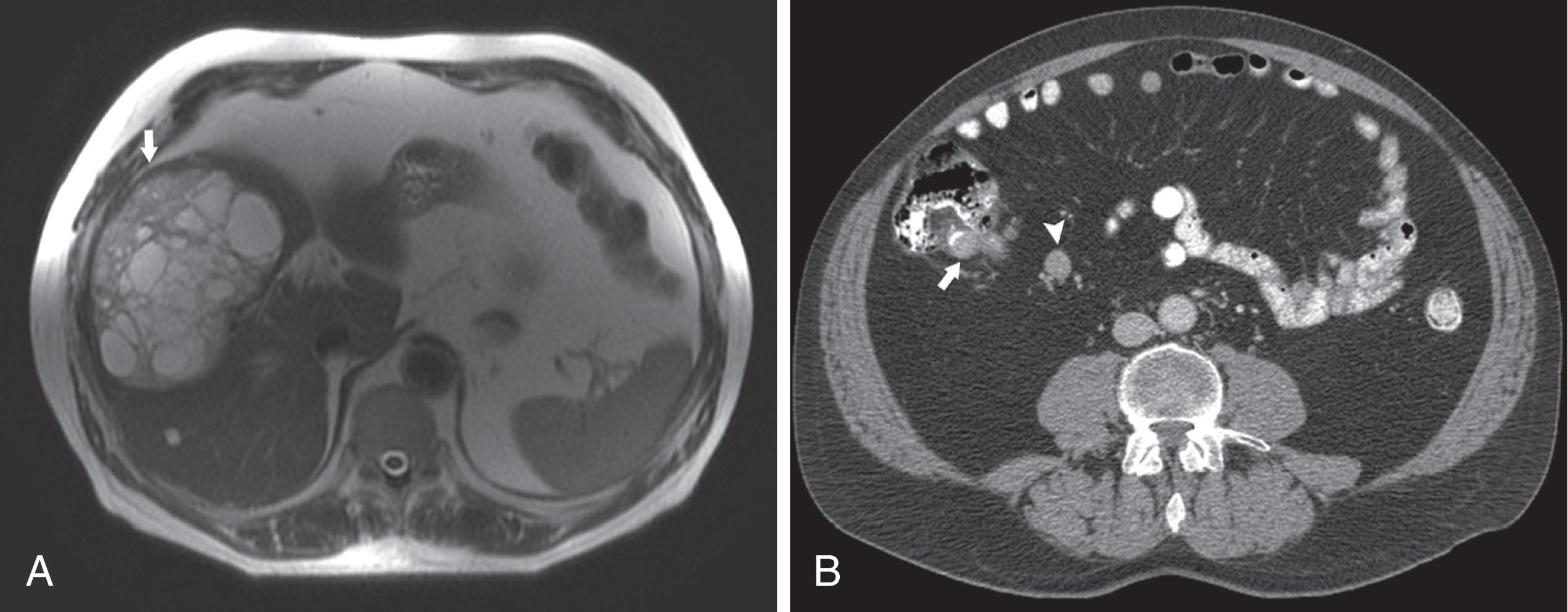 Figure 17.7, A 67-year-old man with acute onset of right upper quadrant pain. A , Single-shot fast spin echo T2-weighted magnetic resonance imaging shows predominantly cystic low-grade neuroendocrine carcinoma liver metastasis ( arrow ). B , Computed tomography shows a small tumor in the terminal ileum ( arrow ) and a small mesenteric nodal metastasis ( arrowhead ).