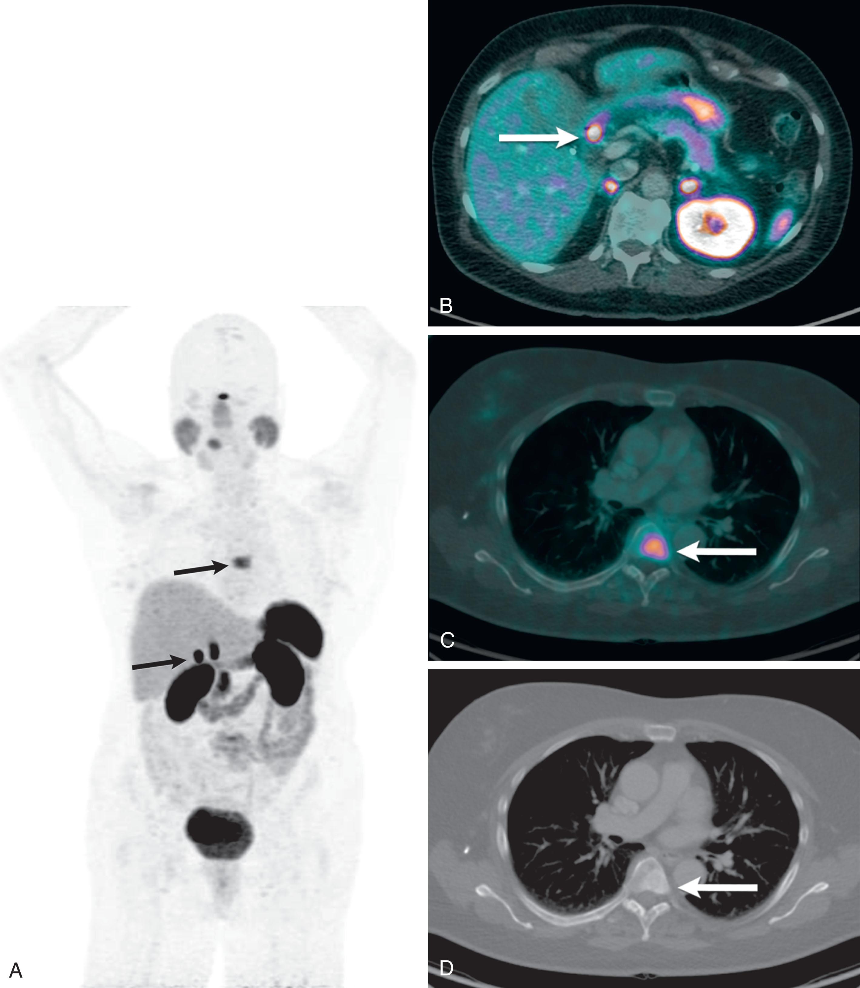 Figure 17.8, A 68-year old woman with duodenal carcinoid tumor identified on endoscopy. A , Maximum intensity projection image from Ga-DOTATATE positron emission tomography/computed tomography (CT) scan showing expected uptake in the known duodenal primary tumor, and an unexpected focus in the spine ( arrows ). Normal uptake is noted incidentally at other sites, including the pituitary, salivary glands, liver, spleen, adrenals, and genitourinary system, and along the bowel. B , Axial fused image showing focal intense uptake in the known duodenal primary ( arrow ). C and D , Axial fused and CT images show a somatostatin-avid sclerotic osseous metastasis ( arrows ).