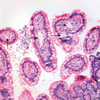 Figure 59-4, Photomicrograph of lymphangiectasia (secondary). Small bowel biopsy showing villi with dilated lacteals ( arrows ). Hematoxylin and eosin stain.