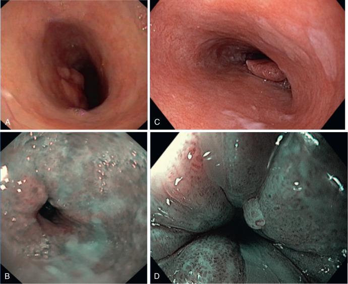 FIG 11.1, Example of an esophageal carcinoma viewed with a transnasal endoscope (Olympus N180, Tokyo, Japan) and a conventional gastroscope (Olympus HQ 190, Tokyo, Japan). A, Transnasal endoscopy picture with white light imaging. B, Transnasal endoscopy picture with narrow band imaging. C, Conventional endoscopy picture with white light imaging. D, Conventional endoscopy picture with narrow band imaging and dual focus magnification.