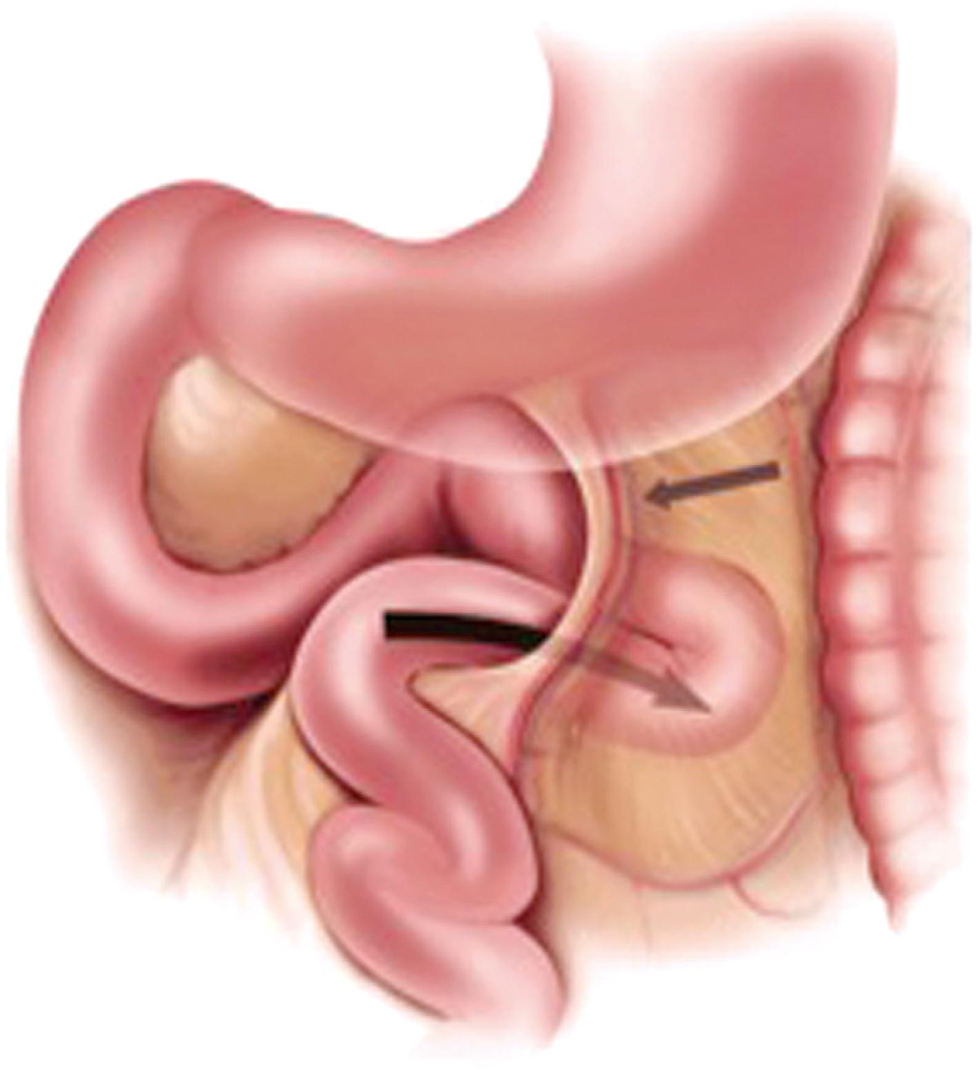 Fig. 78.1, Diagram of Internal Hernia.