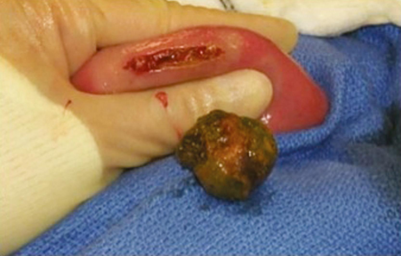 Fig. 78.3, Gallstone Ileus of the Small Intestine at Laparotomy.