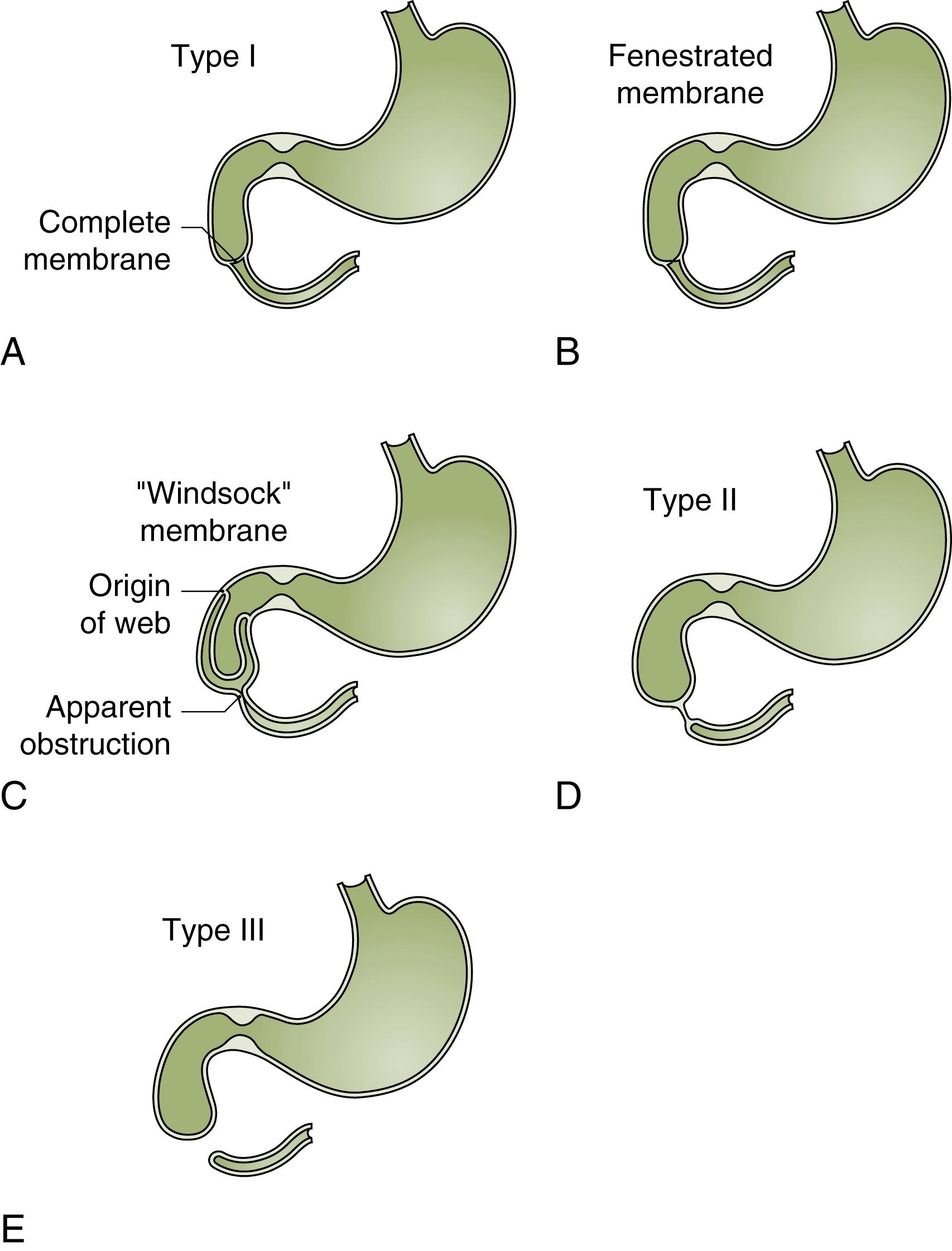 Fig. 57.2, Classification of duodenal atresia. Type I atresia describes obstruction by a membrane. This can be complete (A) or fenestrated (B). In the latter case, partial passage of enteric contents and air distally is seen. Panel (C) depicts a windsock deformity where the web is elongated and terminates well beyond its point of origin. Type II atresia has a fibrous band connecting the two blind ends (D). Type III atresia has completely separate blind-ending proximal and distal segments (E).