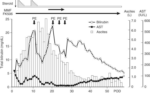 FIGURE 55-2, Clinical course of small-for-size syndrome. The recipient was a 37-year-old female patient with primary biliary cirrhosis. The graft was a 320-g (graft volume–to–standard liver volume ratio, 31.6%; graft weight–to–body weight ratio, 0.77%) left lobe plus caudate lobe graft from her 47-year-old sister. AST , Aspartate aminotransferase; MMF , mycophenolate mofetil; PE , plasma exchange; POD , postoperative day.