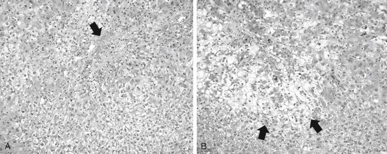 FIGURE 55-4, Typical histopathological findings in grafts with small-for-size graft syndrome. A, Periportal hemorrhage (arrow) . B, Centrilobular hepatocyte ballooning and cholestasis (arrows) .