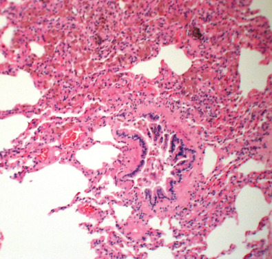 Fig. 34.2, Respiratory bronchiolitis–interstitial lung disease: histologic features. Histopathologic specimen shows extensive accumulation of pigmented macrophages in alveoli and bronchioles in a bronchiolocentric distribution.