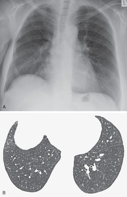 Fig. 34.3, Respiratory bronchiolitis–interstitial lung disease: radiologic findings. (A) Chest radiograph shows subtle reticulonodular pattern in the middle and lower zones. (B) The appearances are more apparent on a concurrent high-resolution CT scan, which shows ill-defined micronodules.