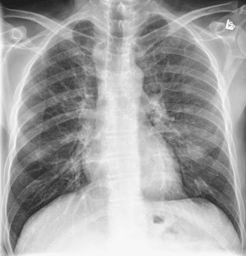 Fig. 34.4, Respiratory bronchiolitis–interstitial lung disease: ground-glass opacities. Chest radiograph shows poorly defined hazy opacities (ground-glass opacities) in the middle and lower lung zones.