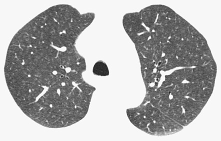 Fig. 34.5, Respiratory bronchiolitis: high-resolution CT (HRCT) findings in an asymptomatic heavy smoker. HRCT scan shows bilateral poorly defined centrilobular nodules.