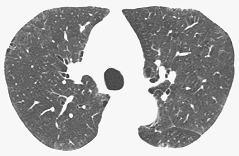 Fig. 34.6, Respiratory bronchiolitis–interstitial lung disease: characteristic CT findings. High-resolution CT scan shows bilateral ground-glass opacities and mild paraseptal emphysema. Note a few poorly defined micronodules.