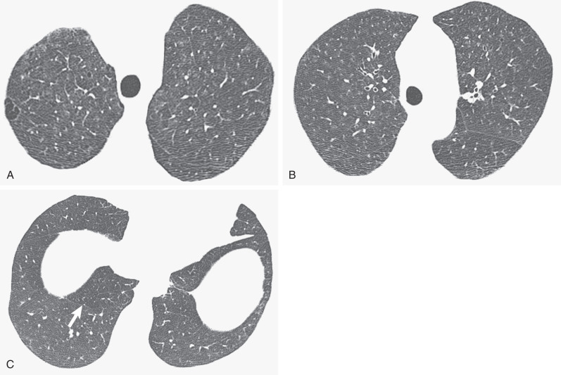 Fig. 34.7, Respiratory bronchiolitis–interstitial lung disease: characteristic CT findings. (A) and (B) High-resolution CT (HRCT) scans show patchy ground-glass opacities, ill-defined centrilobular micronodules, and a few thickened interlobular septa. Note mild paraseptal and centrilobular emphysema. (C) HRCT scan at the level of lower lobes shows bilateral ground-glass opacities and areas of decreased attenuation and vascularity (arrow).