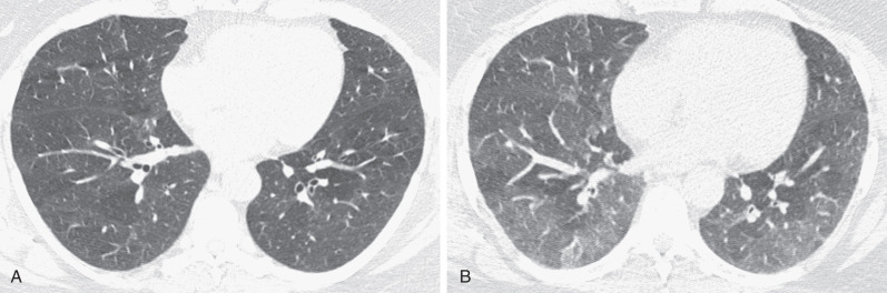 Fig. 34.8, Respiratory bronchiolitis–interstitial lung disease: air trapping on high-resolution CT (HRCT). (A) HRCT scan at inspiration shows mosaic attenuation. (B) CT scan at end expiration shows accentuation of the mosaic attenuation as a result of air-trapping.
