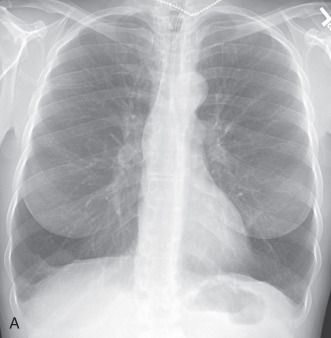 Figure 18.2, Panlobular emphysema on chest radiographs. (A) On the frontal radiograph, findings include lower lung hyperlucency and decreased vascular markings. (B) On the lateral radiograph, the diaphragms are markedly flattened, and lower lung hyperlucency is pronounced.