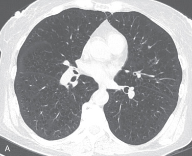 Figure 18.3, Types of emphysema on axial CT scans. (A) Centrilobular emphysema. Numerous areas of low attenuation in the center of the secondary pulmonary lobule, with surrounding normal parenchyma, result in an appearance of low-attenuation holes in the lung. (B) Paraseptal emphysema, characteristic subpleural location (arrows). (C) Panlobular emphysema. Confluent low attenuation of the entire secondary pulmonary lobule results in diffuse low attenuation. There is also a degree of lower lung bronchiectasis, typical of alpha-1-antitrypsin deficiency (arrows).