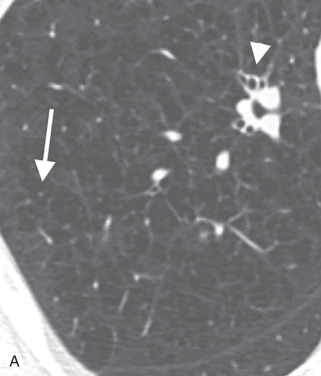 Figure 18.4, Centrilobular emphysema on axial CT scan versus pulmonary cysts. (A) Coned image of centrilobular emphysema. A low-attenuation area is greatest in the center of the pulmonary lobule, with the corresponding centrilobular artery identified (arrow). Also note the bronchial wall thickening (arrowhead) frequently seen in smokers (but nonspecific and found in other causes of inflammatory airway disease). (B) Coned image of pulmonary cystic disease. Rounded areas of low attenuation all have well-defined walls and no discrete relation to the secondary pulmonary lobule.