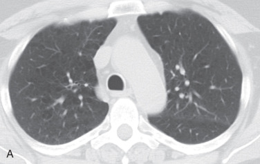 Figure 18.5, Qualitative severity of centrilobular emphysema on axial CT. Mild (A), moderate (B), and severe (C) centrilobular emphysema related to smoking. Note the increasing degree of confluence, with the severe emphysema being indistinguishable from panlobular emphysema (see Fig. 18.3C ) except by clinical history and craniocaudal distribution.