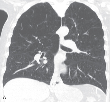 Figure 18.6, CT for evaluation of lung volume reduction surgery (LVRS). (A) A coronal CT image of the chest demonstrates upper lung predominant emphysema, making this patient an ideal candidate for LVRS. (B) A coronal CT scan of the chest demonstrates a much more diffuse centrilobular emphysema related to smoking. This patient is not ideal for LVRS.