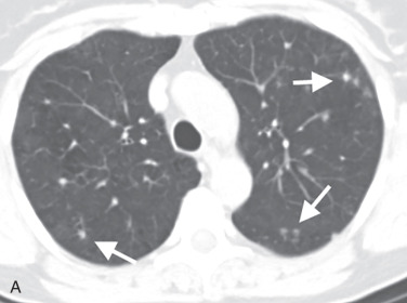 Figure 18.7, Pulmonary Langerhans cell histiocytosis. (A) Axial CT scan demonstrating typical findings more early in the course of disease, dominated by upper lung predominant nodules (arrows). (B) Axial CT scan demonstrating findings more typical of a mid-disease course, a combination of upper lung predominant nodules (arrows) and irregular cysts (arrowheads). (C) Axial CT scan demonstrating findings typical of late disease, dominated by irregular cysts, with a component of distortion and fibrosis.