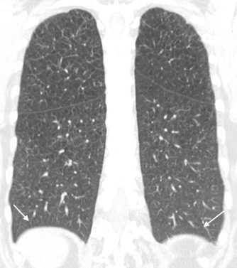 Figure 18.8, Pulmonary Langerhans cell histiocytosis. This coronal CT scan demonstrates typical sparing of the costophrenic angles (arrows), even late in the disease course of this patient.