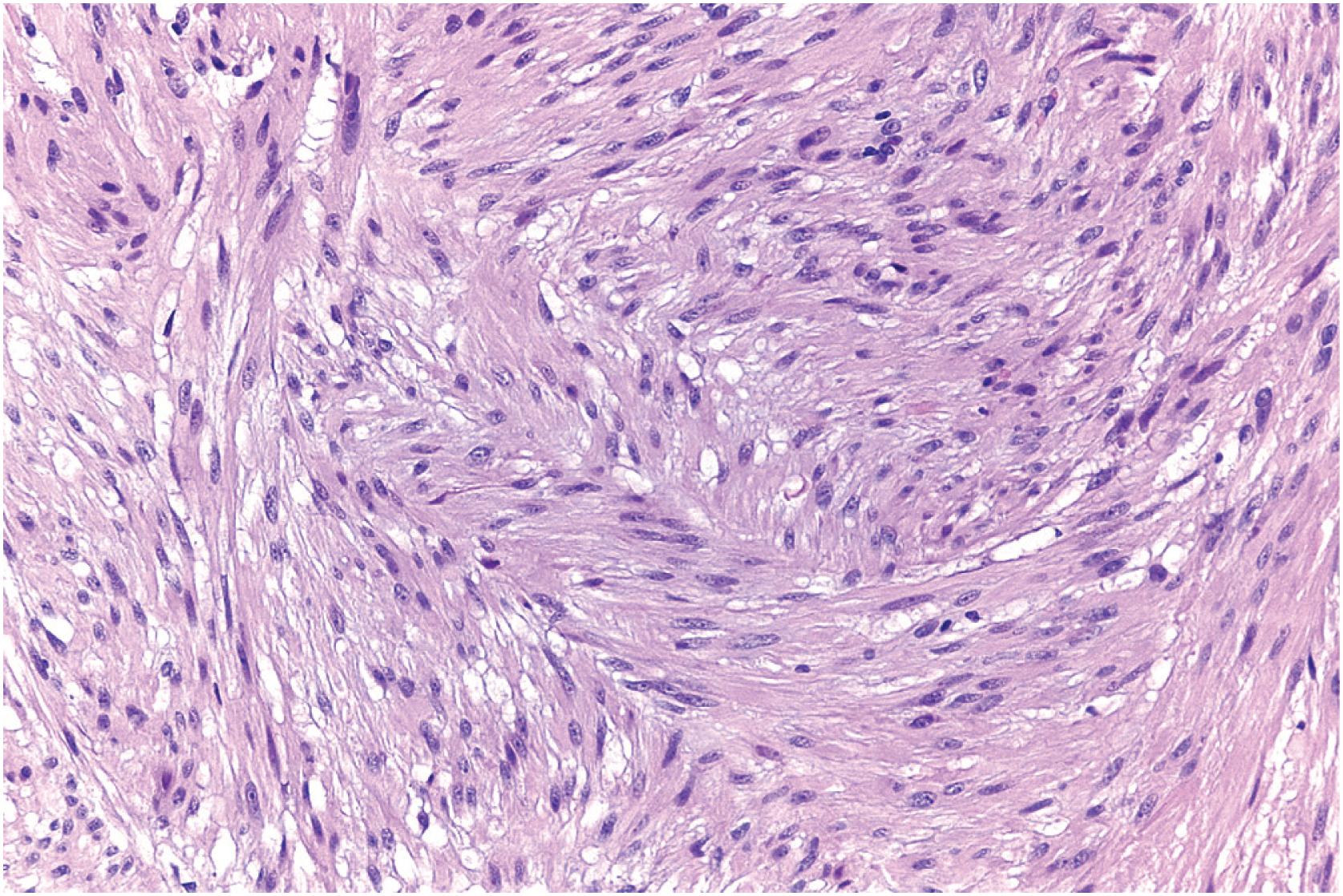 Fig. 6.1, Leiomyoma composed of fascicles of bland spindled cells with blunt-ended nuclei and cytoplasmic vacuolation.