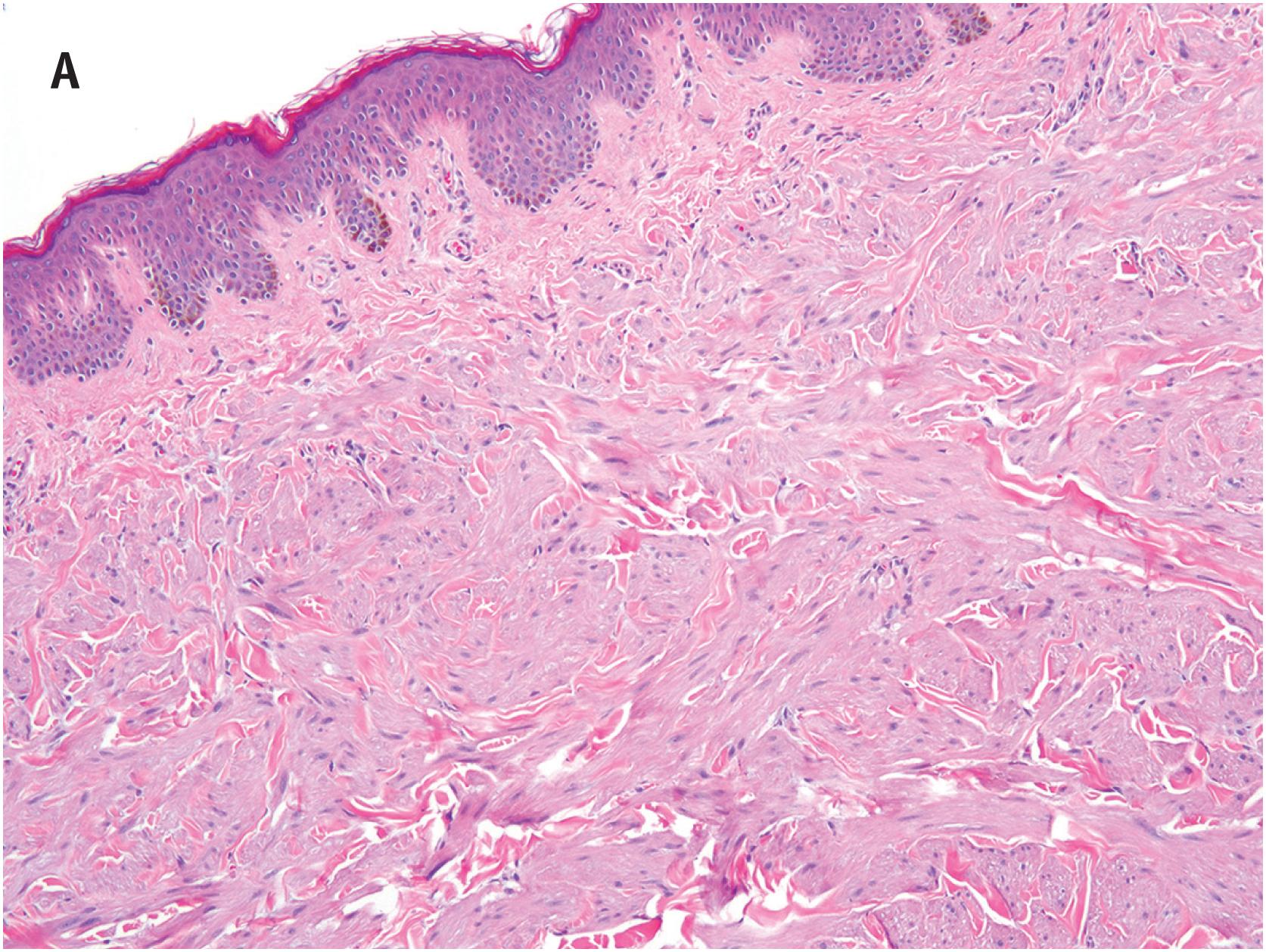 Fig. 6.2, (A) Pilar leiomyoma, consisting of a generally circumscribed, somewhat haphazard proliferation of very bland smooth muscle, closely resembling normal pilar smooth muscle. (B) Higher power view of uniformly bland cells in pilar leiomyoma