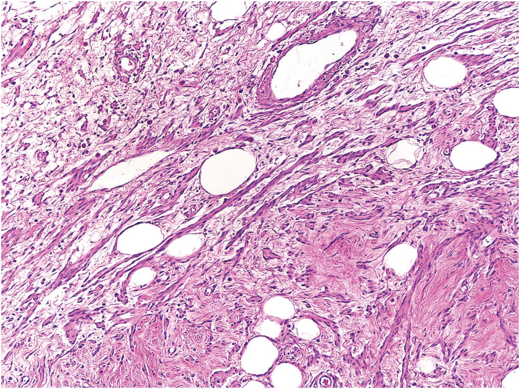 Fig. 6.3, Cord-like pattern in retroperitoneal-abdominal cavity leiomyoma. Many of these lesions closely resemble uterine leiomyomas.