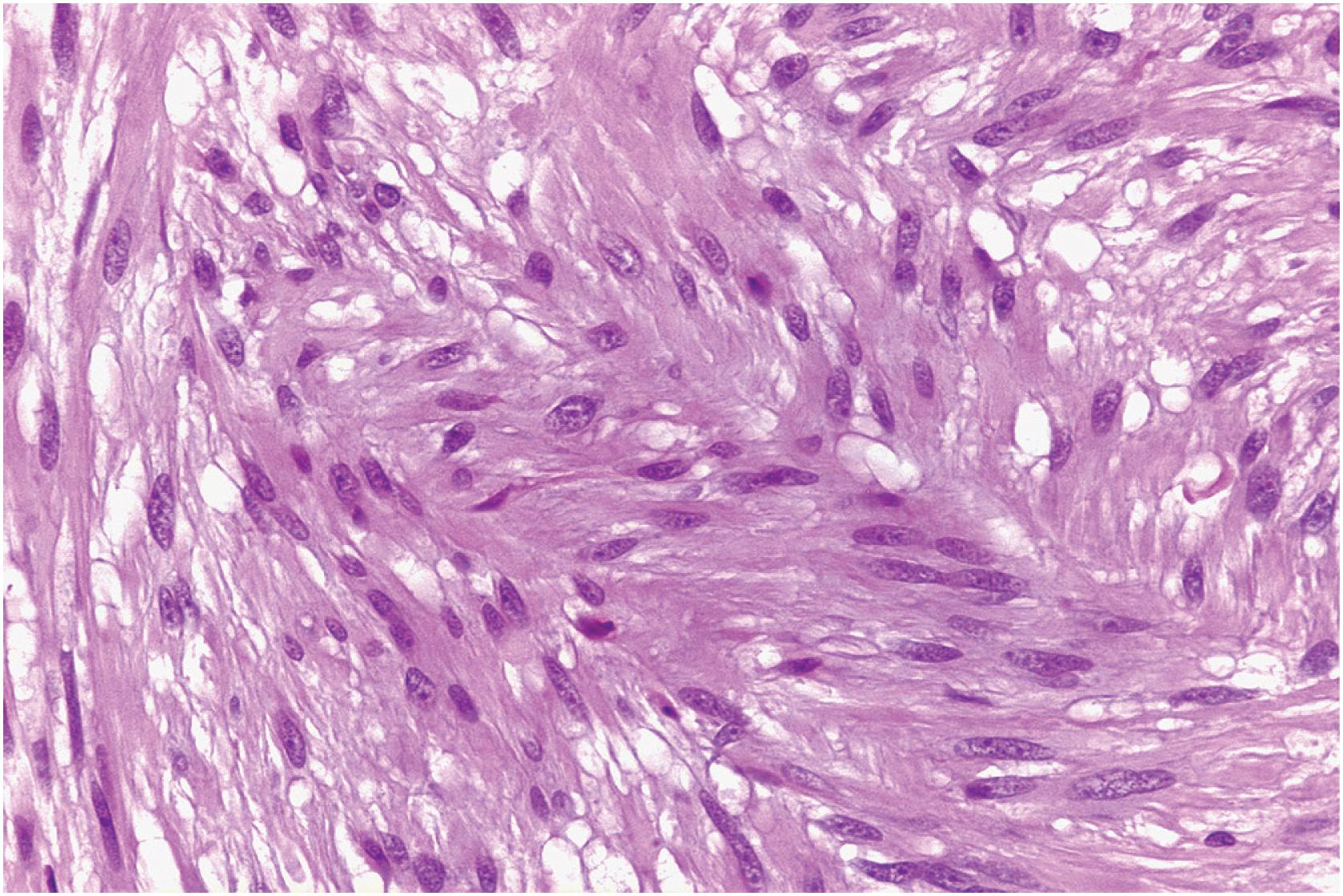 Fig. 6.4, Leiomyoma of deep soft tissue displaying bland nuclear features and cytoplasmic vacuolation.