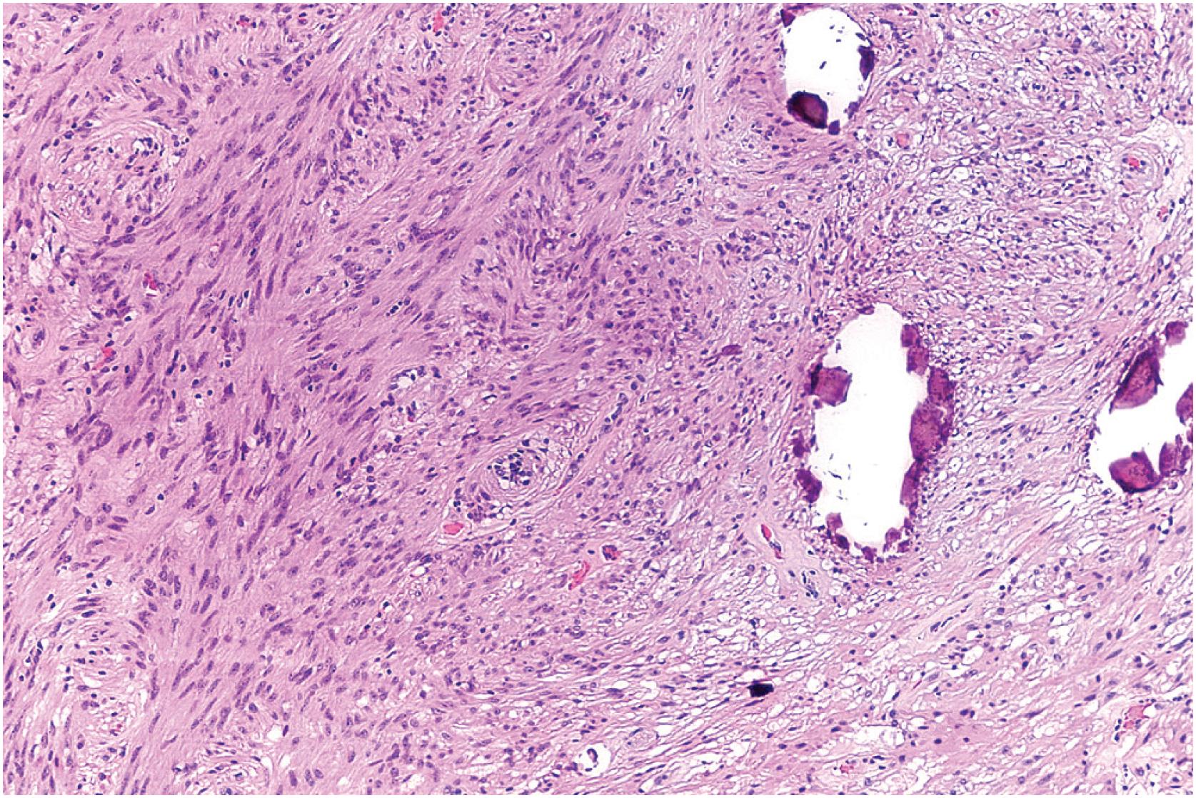 Fig. 6.5, Calcifications in leiomyoma of deep soft tissue.